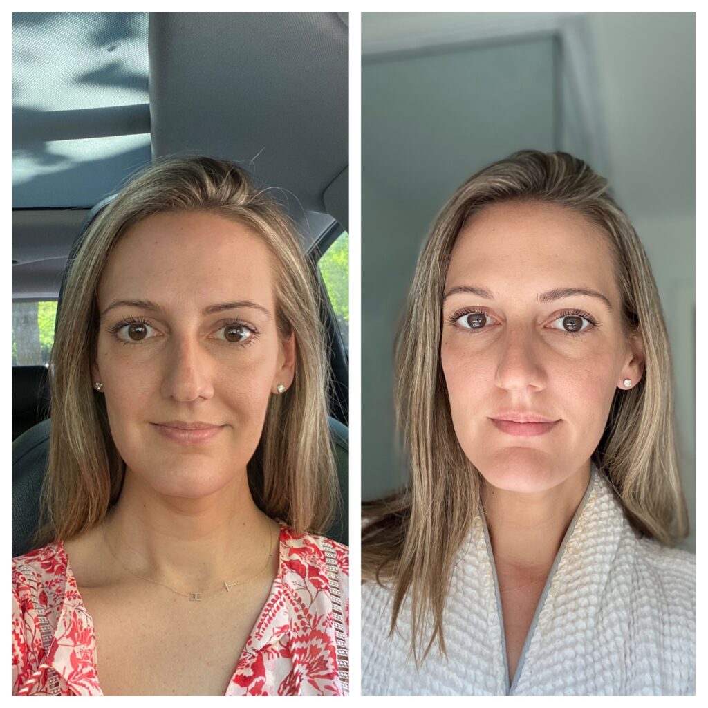 before and after of woman first time botox