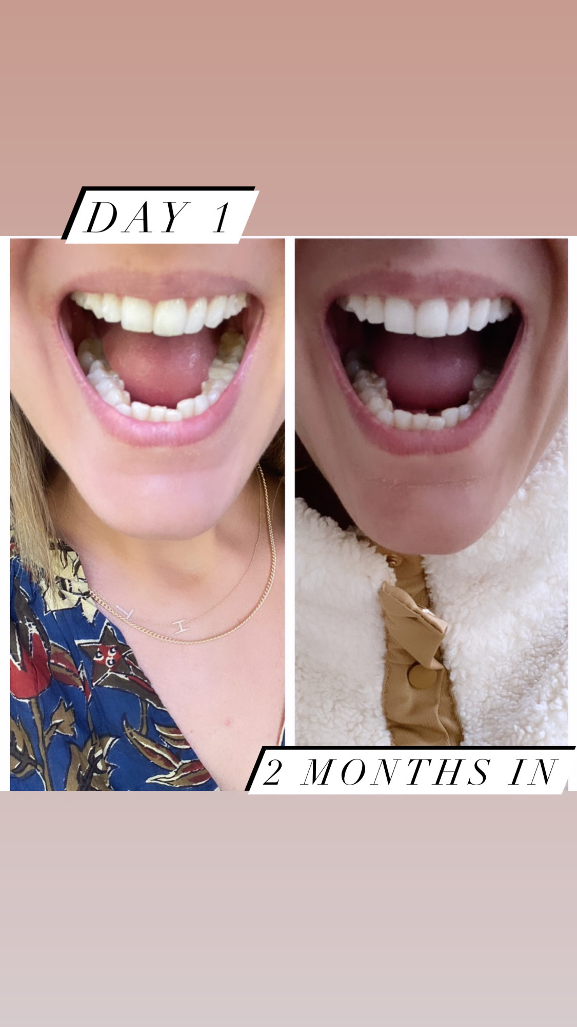 woman showing her Invisalign before and after photos results
